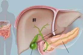 体检查出胆囊息肉，严重吗？怎么才能消除？放着不管会不会癌变？视频封面