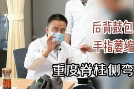 重度脊柱侧弯造成后背鼓包手指萎缩，患者：我以前没有这么严重啊视频封面