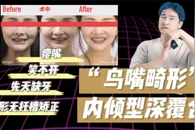 内倾型深覆合“小鸟嘴”，隐形矫正要怎么打开咬颌？面型怎么办？视频封面