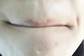 脸下巴长出的白色小颗粒，究竟是什么东西呢？今天终于有答案了视频封面