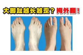 大脚趾越长越歪？拇外翻！视频封面
