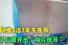 用阿维a治7年牛皮癣，男子后腰开出“梅花斑疹”，后背又痒又疼视频封面
