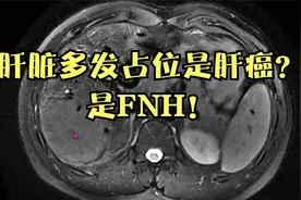 25岁小伙查体发现肝脏多发占位，是肝癌吗？普美显告诉你真相！视频封面