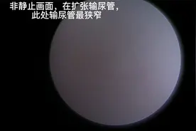 输尿管镜检查输尿管全过程，无删减视频封面