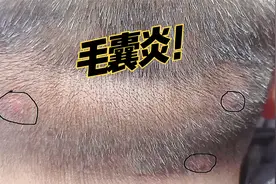 后脑勺长了几个疙瘩，一直不好，要小心毛囊炎。