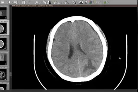 CT入门教学（1）：头颅CT该怎么看？视频封面