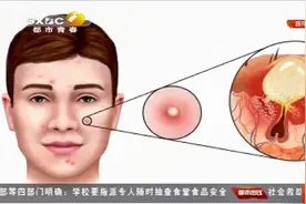 "三角区"的痘痘别乱挤!浙江19岁女孩挤痘痘引发颅内感染|都市热线