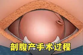 剖腹产分娩全过程，竟然要腹开7层，比想象的要痛，妈妈太不容易视频封面