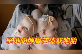这对可怜的颅骨连体双胞胎姐妹 她们的分离手术能否成功（上）视频封面