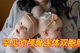 这对可怜的颅骨连体双胞胎姐妹 她们的分离手术能否成功（上）视频封面