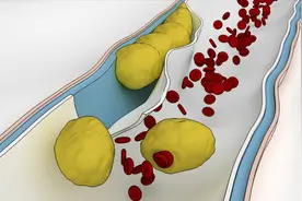 肌间静脉血栓严重吗，有没有生命危险？医生讲：需重视、需处理视频封面