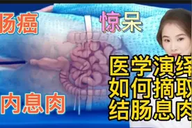 医学手术 结肠癌 结肠息肉 看医生如何利用仪器和技术进行摘取视频封面