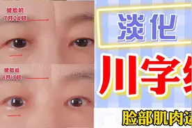 头部帽状腱膜紧张会皱眉头，川字纹十分难看，直播间一个动作改善视频封面