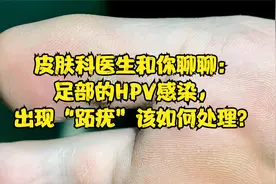 皮肤科医生和你聊聊：足部的HPV感染，出现“跖疣”该如何处理？视频封面