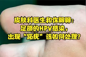 皮肤科医生和你聊聊：足部的HPV感染，出现“跖疣”该如何处理？视频封面