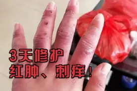 冻伤后手指又疼又痒？过来人有个方法简单又实用，红肿痒全消了！视频封面