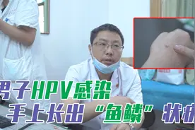 男子HPV感染，手上长出“鱼鳞”状疣，抠破还会传染视频封面