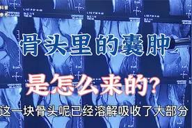为什么骨头里会出现囊肿？囊肿是怎么来的？肖教授分析病例讲解视频封面