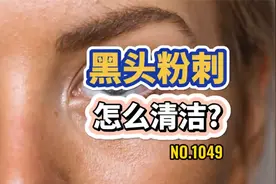 黑头粉刺怎么清洁？