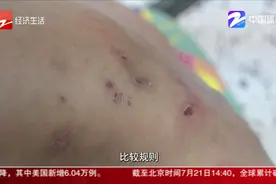 脚上红疹连成片还奇痒无比 潮湿闷热的天气尤其要注意视频封面