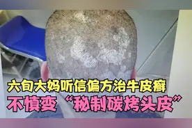 六旬大妈仙人掌煎药涂头，不慎变“秘制炭烤头皮”，吓跑广场舞伴视频封面