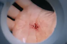 男子手心长了8个洞，每天都流出大量血，医生都拿它没办法视频封面