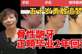 47岁矫正骨性龅牙，50岁复查保持器，现在效果如何？牙齿会松吗？视频封面
