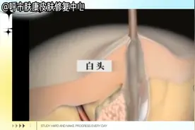 动画演示长痘痘全过程！