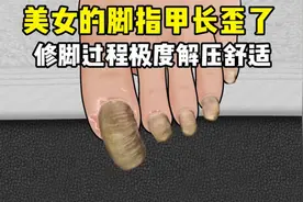 脚上出现又长又粗脚指甲，修脚大师看了都摇了摇头，全程超级解压视频封面