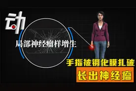 手指被钢化膜扎破长出神经瘤：手术后发现毫米级碎片