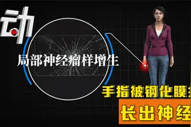 手指被钢化膜扎破长出神经瘤：手术后发现毫米级碎片