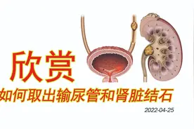 3D动画：如何取出输尿管和肾脏结石视频封面
