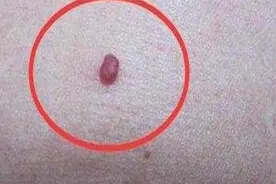 中老年人身上长了不疼不痒的红点，咋回事？要治疗吗？视频封面