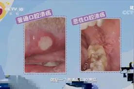 警惕！口腔溃疡呈现“菜花状”别大意，可能是恶性的|健康之路视频封面