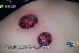 有人因拔火罐导致烫伤或烧伤，实验员用实验进行解答|真相123视频封面