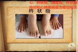 心、肺疾病，指趾知，杵状指绝对和心肺疾病最为密切相关视频封面