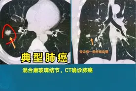这个肺癌，CT片可以确诊，不用穿刺，肺腺癌视频封面