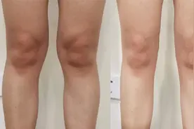 膝盖内侧鼓包堆肉、腿不直怎么办？1招改善，腿直了也细了！视频封面