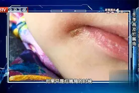 冬季烂嘴角频发，皮肤科医生教你一招缓解！视频封面