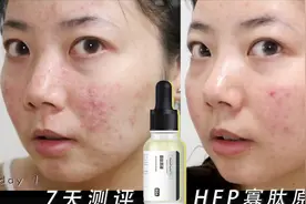 网红护肤品痘肌一周实测|hfp寡肽原液祛痘效果到底怎样？视频封面
