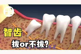 智齿痛难忍？医生告诉你：拔与不拔的正确选择！