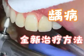 全新龋病治疗：不需要磨牙，直接修复牙齿的神奇药水，一滴就足够视频封面