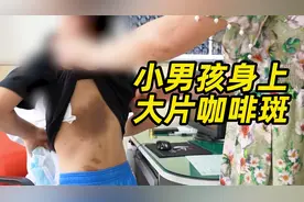 小男孩身上出现大片牛奶咖啡斑，如何治疗仍然是一大医学难题视频封面