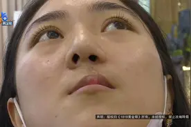 【1818黄金眼】唇裂修复后  不能侧着睡？视频封面