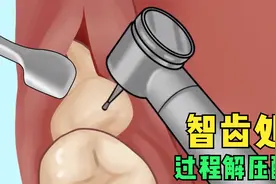 智齿蛀牙处理全过程，看着简单实则酸爽，你有体验过吗？视频封面