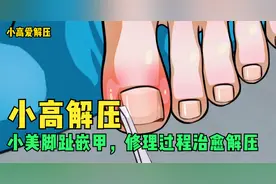 小美洗澡时发现脚趾嵌甲，急忙找修脚师治疗，过程治愈解压！