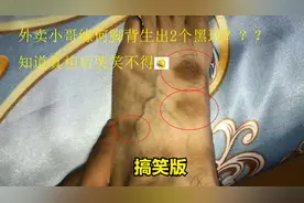 外卖小哥缘何脚背长了2个大黑斑？发现原因后非常尴尬搞笑视频封面