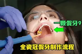 4分钟让你快速了解假牙（全瓷冠）制作流程，牙齿变白颜色好看视频封面