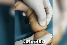 束带综合征的宝宝被勒严重会截肢，束带宝宝的蜕变之旅视频封面
