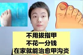 很多医生不知道的妙招，一根棉花从根源上治愈甲沟炎，基本不复发视频封面